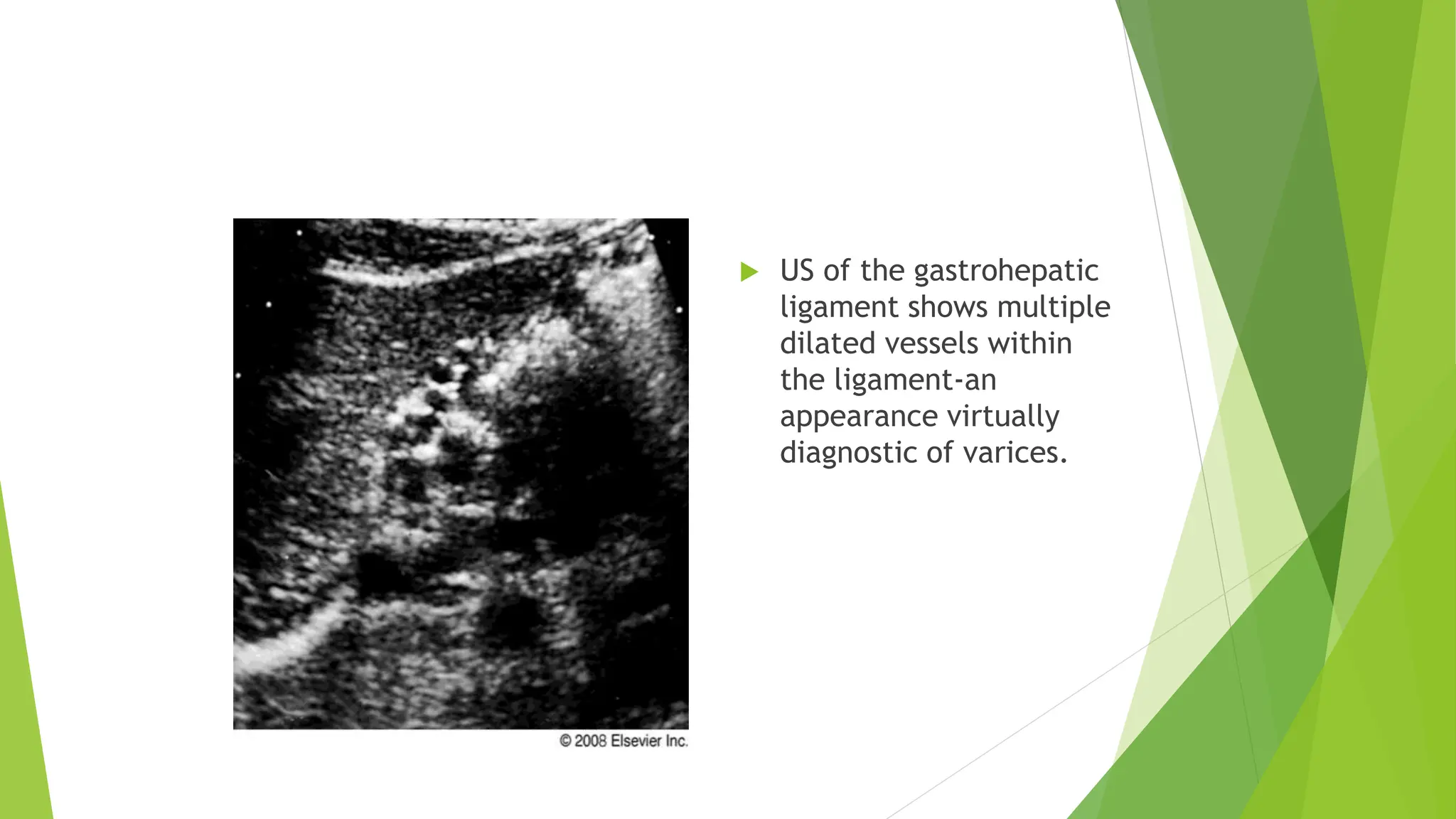 UPPER GI PATH SMD.pptx on upper GI bleeding | PPTX