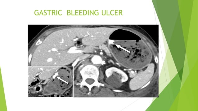 UPPER GI PATH SMD.pptx on upper GI bleeding | PPT