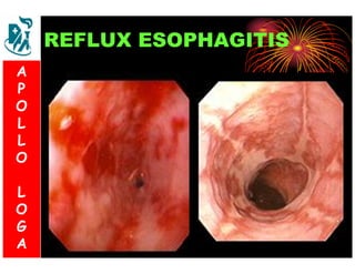 REFLUX ESOPHAGITIS 
A 
P 
S 
O 
L 
& 
L 
V 
O 
L 
O 
G 
A 
L 
O 
G 
A 
 