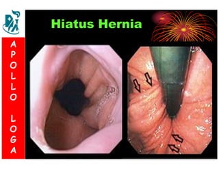 Hiatus Hernia 
A 
P 
S 
O 
L 
& 
L 
V 
O 
L 
O 
G 
A 
L 
O 
G 
A 
 