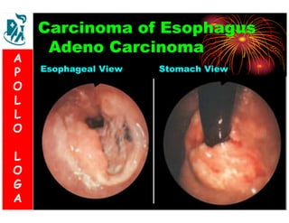Carcinoma of Esophagus 
Adeno Carcinoma 
Esophageal View Stomach View 
A 
P 
O 
L 
L 
O 
L 
O 
G 
A 
 