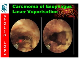 Carcinoma of Esophagus 
Laser Vaporisation 
A 
P 
O 
L 
L 
O 
L 
O 
G 
A 
 