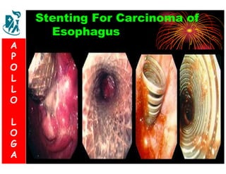 Stenting For Carcinoma of 
Esophagus 
A 
P 
S 
O 
L 
& 
L 
V 
O 
L 
O 
G 
A 
L 
O 
G 
A 
 