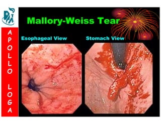 Mallory-Weiss Tear 
Esophageal View Stomach View 
A 
P 
S 
O 
L 
& 
L 
V 
O 
L 
O 
G 
A 
L 
O 
G 
A 
 