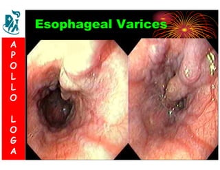 Esophageal Varices 
A 
P 
S 
O 
L 
& 
L 
V 
O 
L 
O 
G 
A 
L 
O 
G 
A 
 