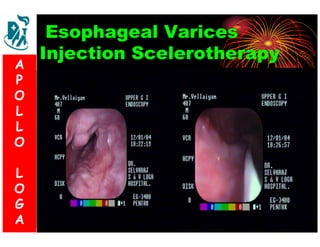 Esophageal Varices 
Injection Scelerotherapy 
A 
P 
S 
O 
L 
& 
L 
V 
O 
L 
O 
G 
A 
L 
O 
G 
A 
 