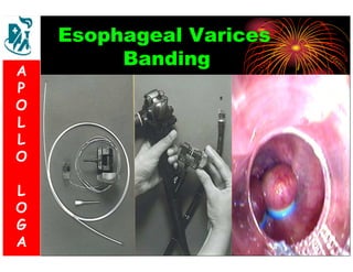 Esophageal Varices 
Banding 
A 
P 
O 
L 
L 
O 
L 
O 
G 
A 
 