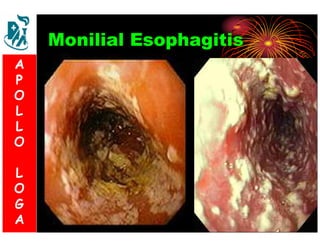 Monilial Esophagitis 
A 
P 
S 
O 
L 
& 
L 
V 
O 
L 
O 
G 
A 
L 
O 
G 
A 
 