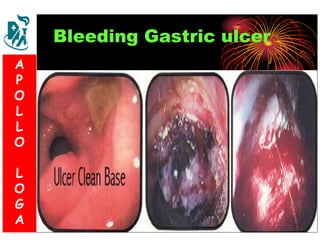 Bleeding Gastric ulcer 
A 
P 
S 
O 
L 
& 
L 
V 
O 
L 
O 
G 
A 
L 
O 
G 
A 
 