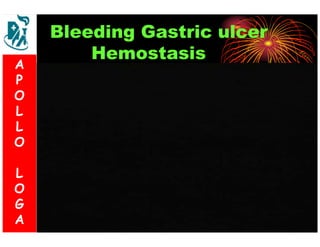 Bleeding Gastric ulcer 
Hemostasis 
A 
P 
O 
L 
L 
O 
L 
O 
G 
A 
 