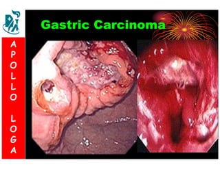 Gastric Carcinoma 
A 
P 
S 
O 
L 
& 
L 
V 
O 
L 
O 
G 
A 
L 
O 
G 
A 
 