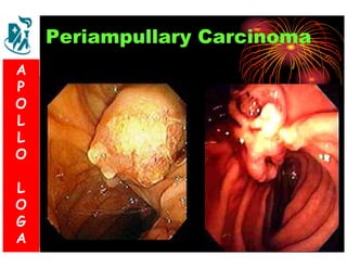 Periampullary Carcinoma 
A 
P 
S 
O 
L 
& 
L 
V 
O 
L 
O 
G 
A 
L 
O 
G 
A 
 