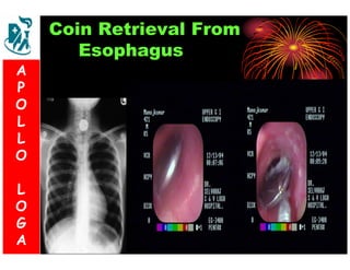 Coin Retrieval From 
Esophagus 
A 
P 
S 
O 
L 
& 
L 
V 
O 
L 
O 
G 
A 
L 
O 
G 
A 
 