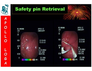 S 
& 
V 
L 
O 
G 
A 
Safety pin Retrieval 
A 
P 
O 
L 
L 
O 
L 
O 
G 
A 
 