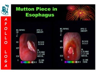 Mutton Piece in 
Esophagus 
A 
P 
S 
O 
L 
& 
L 
V 
O 
L 
O 
G 
A 
L 
O 
G 
A 
 