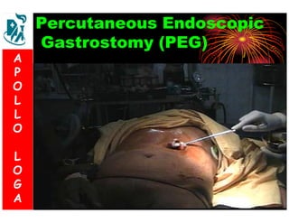 Percutaneous Endoscopic 
Gastrostomy (PEG) 
A 
P 
O 
L 
L 
O 
L 
O 
G 
A 
 