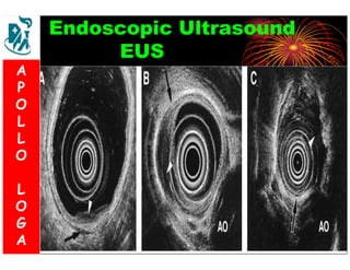 Endoscopic Ultrasound 
EUS 
A 
P 
O 
L 
L 
O 
L 
O 
G 
A 
 