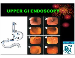 UPPER GI ENDOSCOPY 
Apollo Loga 
 