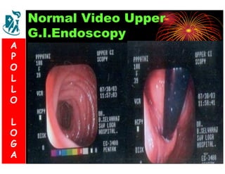 Normal Video Upper 
G.I.Endoscopy 
A 
P 
S 
O 
L 
& 
L 
V 
O 
L 
O 
G 
A 
L 
O 
G 
A 
 