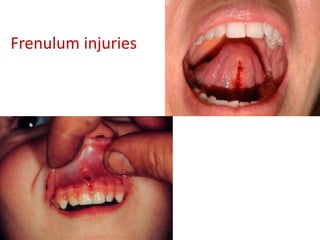 Frenulum Injury Upper Gastrointestinal Tract: Anatomy & Physiology.pdf