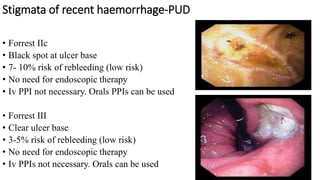 Stigmata of recent haemorrhage-PUD
• Forrest IIc
• Black spot at ulcer base
• 7- 10% risk of rebleeding (low risk)
• No need for endoscopic therapy
• Iv PPI not necessary. Orals PPIs can be used
• Forrest III
• Clear ulcer base
• 3-5% risk of rebleeding (low risk)
• No need for endoscopic therapy
• Iv PPIs not necessary. Orals can be used
 