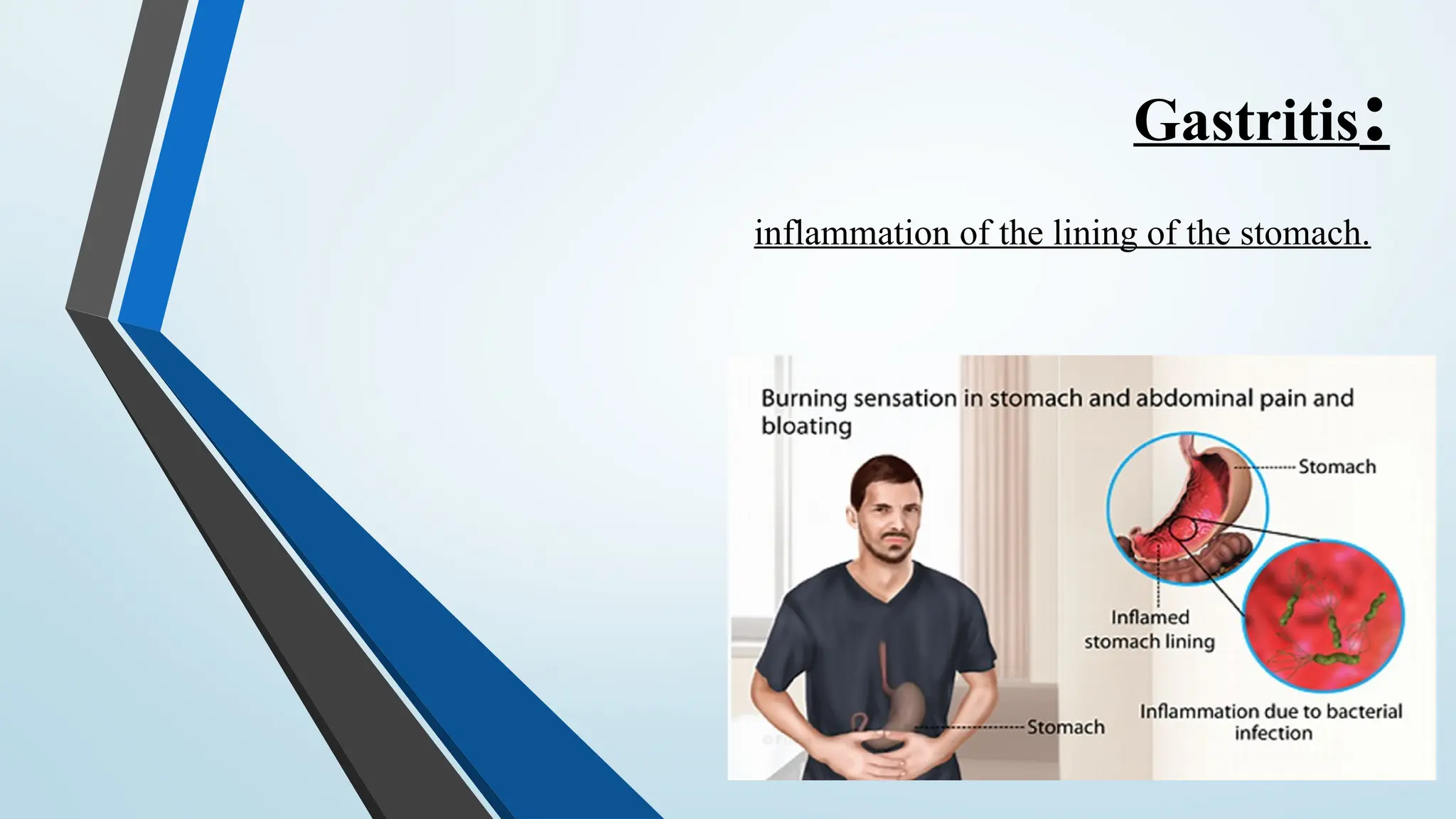 Gastritis:
inflammation of the lining of the stomach.
 