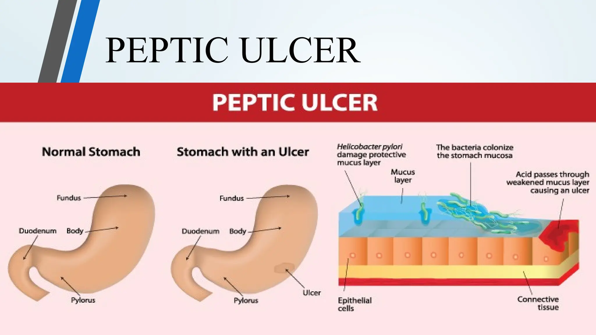 PEPTIC ULCER
 