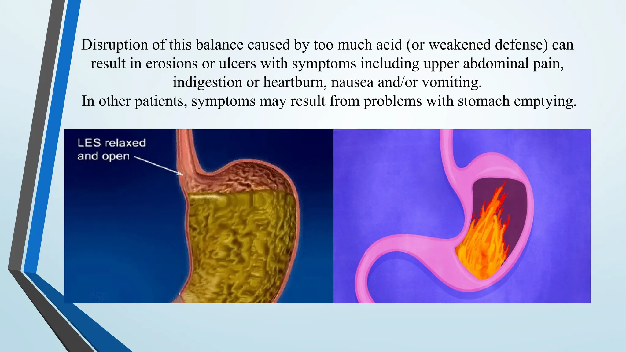 Disruption of this balance caused by too much acid (or weakened defense) can
result in erosions or ulcers with symptoms including upper abdominal pain,
indigestion or heartburn, nausea and/or vomiting.
In other patients, symptoms may result from problems with stomach emptying.
 