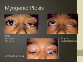 Myogenic Ptosis
MRD1
RE: 5 mm
LE: 1 mm
Upgaze
accentuate ptosis
Downgaze  lid lag
 