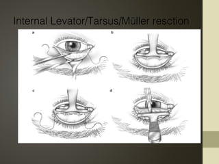 Internal Levator/Tarsus/Müller resction
 