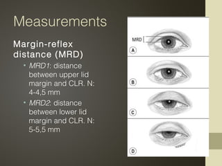 Measurements
Margin-reflex
distance (MRD)
• MRD1: distance
between upper lid
margin and CLR. N:
4-4,5 mm
• MRD2: distance
...