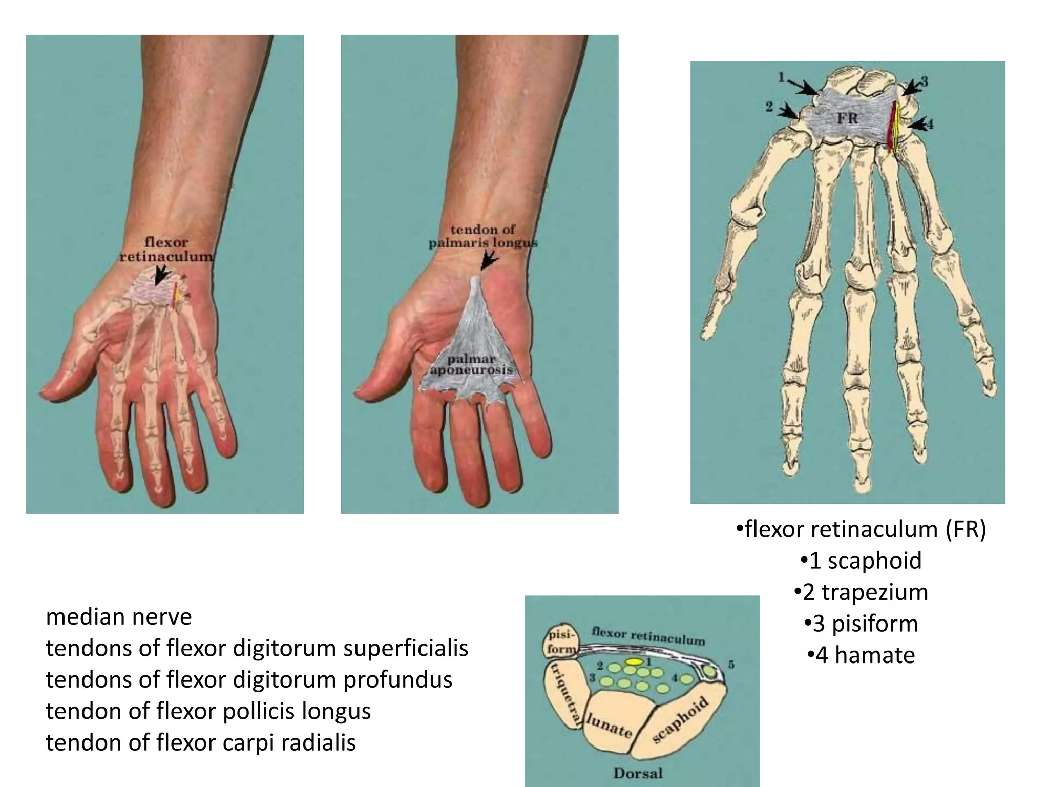 •flexor retinaculum (FR)
                                                   •1 scaphoid
                                                  •2 trapezium
median nerve                                       •3 pisiform
tendons of flexor digitorum superficialis           •4 hamate
tendons of flexor digitorum profundus
tendon of flexor pollicis longus
tendon of flexor carpi radialis
 
