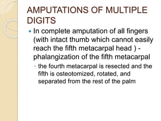 AMPUTATIONS OF MULTIPLE
DIGITS
 In complete amputation of all fingers
(with intact thumb which cannot easily
reach the fifth metacarpal head ) -
phalangization of the fifth metacarpal
◦ the fourth metacarpal is resected and the
fifth is osteotomized, rotated, and
separated from the rest of the palm
 