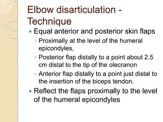 Elbow disarticulation -
Technique
 Equal anterior and posterior skin flaps
◦ Proximally at the level of the humeral
epicondyles,
◦ Posterior flap distally to a point about 2.5
cm distal to the tip of the olecranon
◦ Anterior flap distally to a point just distal to
the insertion of the biceps tendon.
 Reflect the flaps proximally to the level
of the humeral epicondyles
 