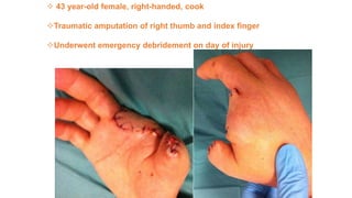  43 year-old female, right-handed, cook
Traumatic amputation of right thumb and index finger
Underwent emergency debridement on day of injury
 