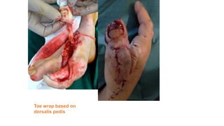 Toe wrap based on
dorsalis pedis
 