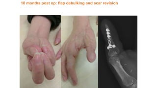 10 months post op: flap debulking and scar revision
 