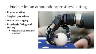 timeline for an amputation/prosthesis fitting
• Preamputation
• Surgical procedure
• Acute postsurgery
• Prosthesis fitting and
testing
• Preparatory vs definitive
prosthesis
 