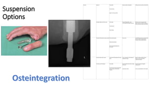 Suspension
Options
Harness Figure-8 Transradial
Transhumeral
Light to normal activities
Simple, durable, adjustable Axillarypressure produces discomfort
Shoulder saddle and chest strap Transradial
Transhumeral
Heavy lifting
Greater liftingability, more
comfortable than figure-8 harness
Reduced control compared with
figure-8 harness; difficultto adjust in
women, because straps cross breasts
Self-suspending Munster Northwestern Supracondylar Wrist disarticulation
Elbow disarticulation
Short transradial Myoelectric
transradial
Ease of use Limitedlifting capacity compared with
harness systems, compromised
cosmesis, reduced elbow flexion
Suction Suction socket with air valve Transhumeral with good soft-tissue
cover
Secure suspension, eliminationof
suspension straps
Requires stable residual volume,
harder to put on than other
suspension systems
Gel sleeve with locking pin Transradial
Transhumeral Compromised limbs
with scarring or impairedskin
integrity
Accommodatelimb volume change
with socks,
reduced skin shear
Greater cleaning and hygiene
requirements,
can be uncomfortablein hot climates
 