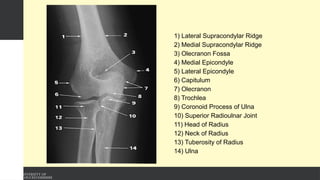1) Lateral Supracondylar Ridge
2) Medial Supracondylar Ridge
3) Olecranon Fossa
4) Medial Epicondyle
5) Lateral Epicondyle
6) Capitulum
7) Olecranon
8) Trochlea
9) Coronoid Process of Ulna
10) Superior Radioulnar Joint
11) Head of Radius
12) Neck of Radius
13) Tuberosity of Radius
14) Ulna
 