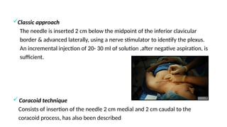 brachial plexus block for upper limb surgery | PPTX