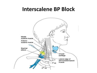 Interpectoral Block Upper limb blocks | PPT