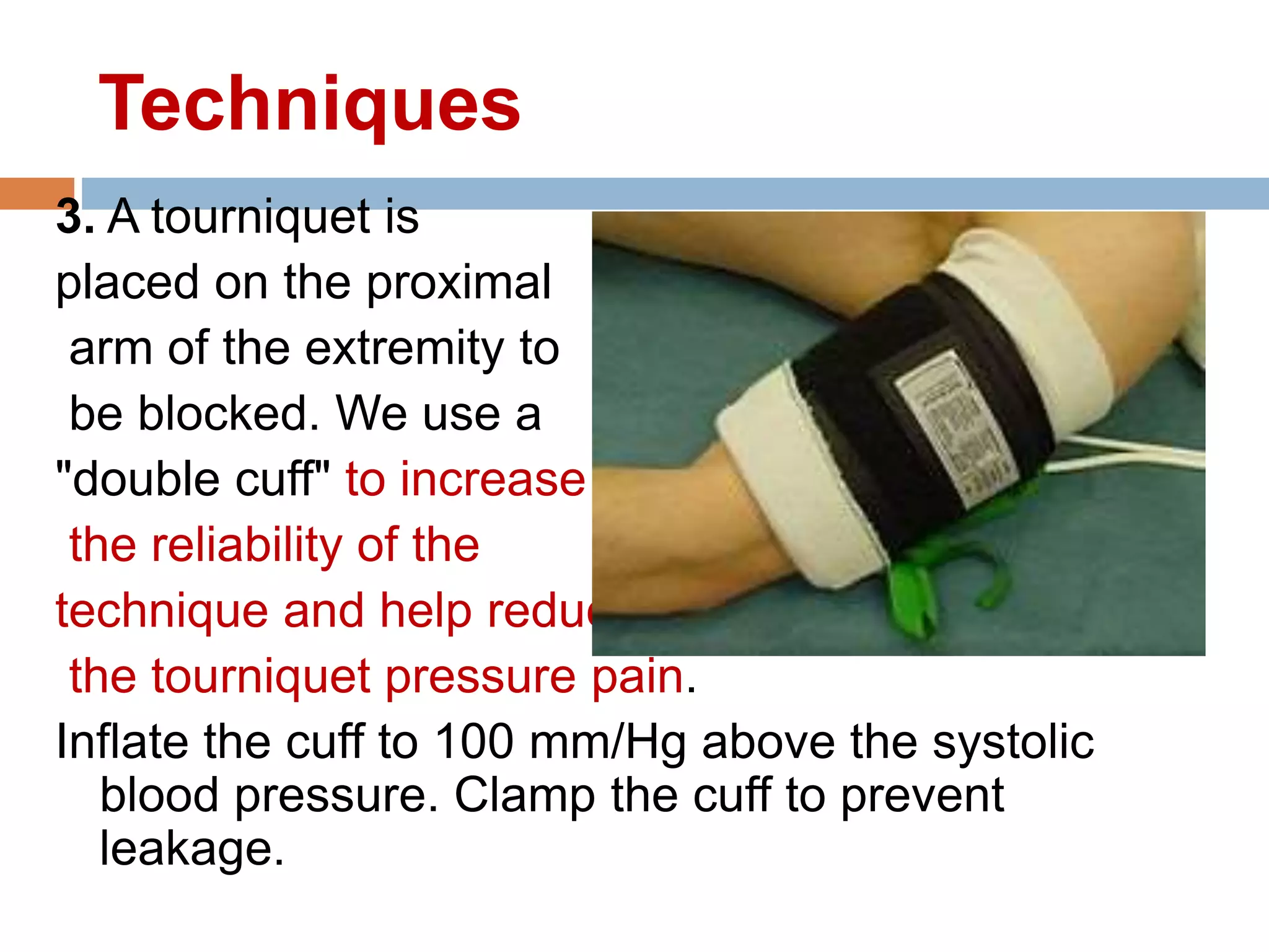 3. A tourniquet is
placed on the proximal
arm of the extremity to
be blocked. We use a
"double cuff" to increase
the reliability of the
technique and help reduce
the tourniquet pressure pain.
Inflate the cuff to 100 mm/Hg above the systolic
blood pressure. Clamp the cuff to prevent
leakage.
Techniques
 