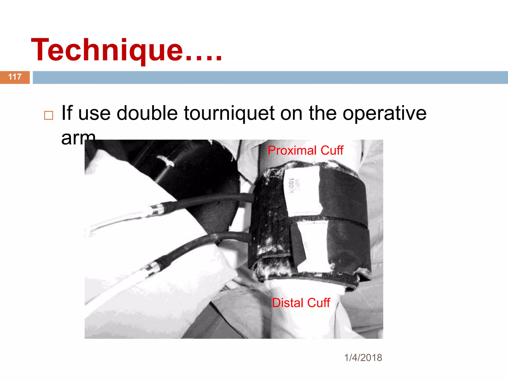  If use double tourniquet on the operative
arm.
Proximal Cuff
Distal Cuff
1/4/2018
117
Technique….
 