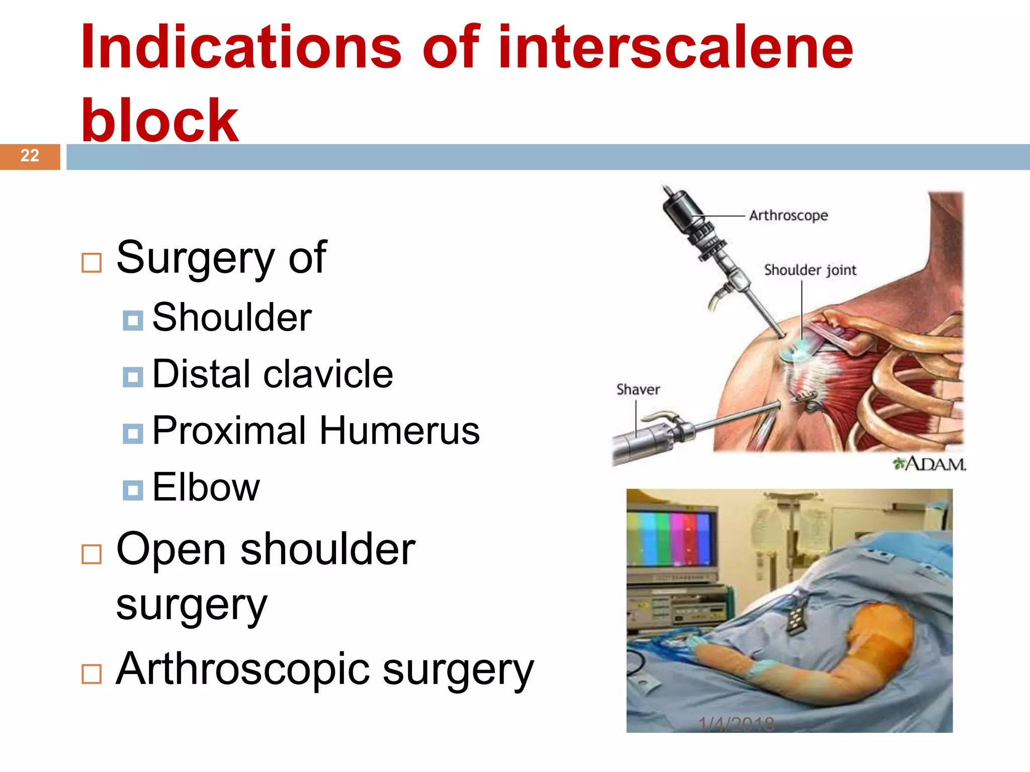 Indications of interscalene
block
 Surgery of
 Shoulder
 Distal clavicle
 Proximal Humerus
 Elbow
 Open shoulder
surgery
 Arthroscopic surgery
1/4/2018
22
 