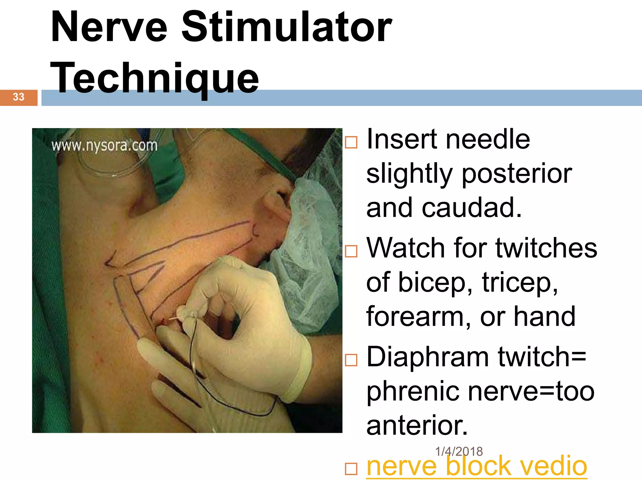 Nerve Stimulator
Technique
 Insert needle
slightly posterior
and caudad.
 Watch for twitches
of bicep, tricep,
forearm, or hand
 Diaphram twitch=
phrenic nerve=too
anterior.
 nerve block vedio
1/4/2018
33
 
