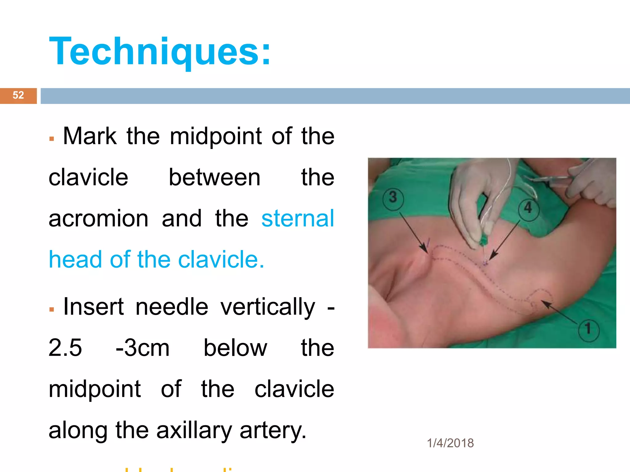 Techniques:
 Mark the midpoint of the
clavicle between the
acromion and the sternal
head of the clavicle.
 Insert needle vertically -
2.5 -3cm below the
midpoint of the clavicle
along the axillary artery. 1/4/2018
52
 