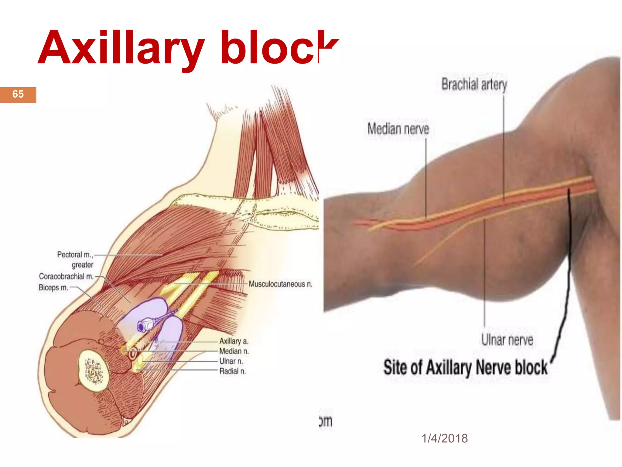 Axillary block
1/4/2018
65
 