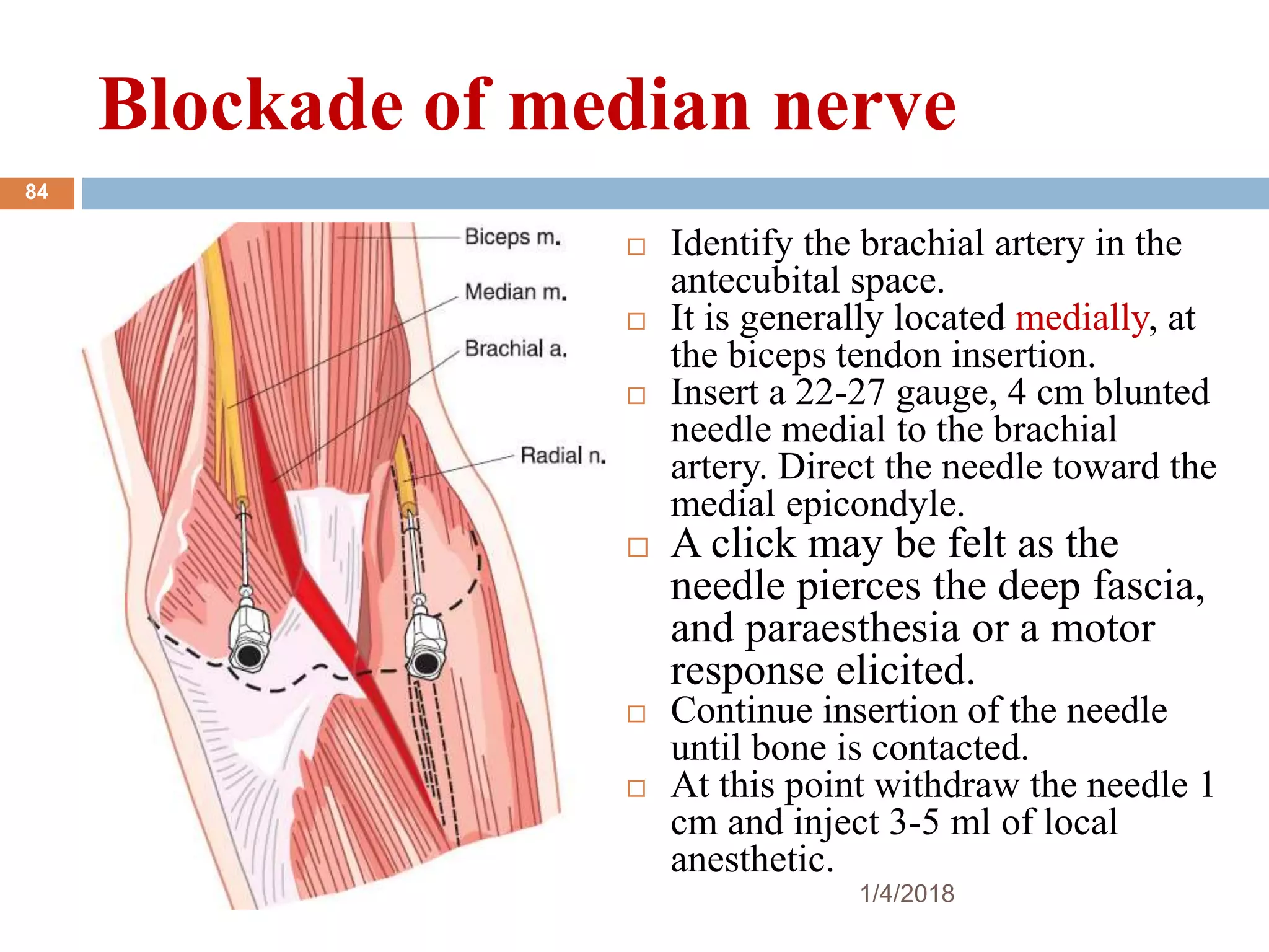 Blockade of median nerve
 Identify the brachial artery in the
antecubital space.
 It is generally located medially, at
the biceps tendon insertion.
 Insert a 22-27 gauge, 4 cm blunted
needle medial to the brachial
artery. Direct the needle toward the
medial epicondyle.
 A click may be felt as the
needle pierces the deep fascia,
and paraesthesia or a motor
response elicited.
 Continue insertion of the needle
until bone is contacted.
 At this point withdraw the needle 1
cm and inject 3-5 ml of local
anesthetic.
1/4/2018
84
 
