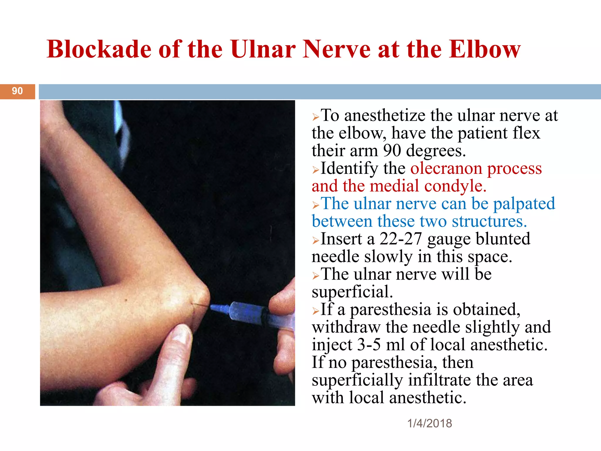 Blockade of the Ulnar Nerve at the Elbow
To anesthetize the ulnar nerve at
the elbow, have the patient flex
their arm 90 degrees.
Identify the olecranon process
and the medial condyle.
The ulnar nerve can be palpated
between these two structures.
Insert a 22-27 gauge blunted
needle slowly in this space.
The ulnar nerve will be
superficial.
If a paresthesia is obtained,
withdraw the needle slightly and
inject 3-5 ml of local anesthetic.
If no paresthesia, then
superficially infiltrate the area
with local anesthetic.
1/4/2018
90
 
